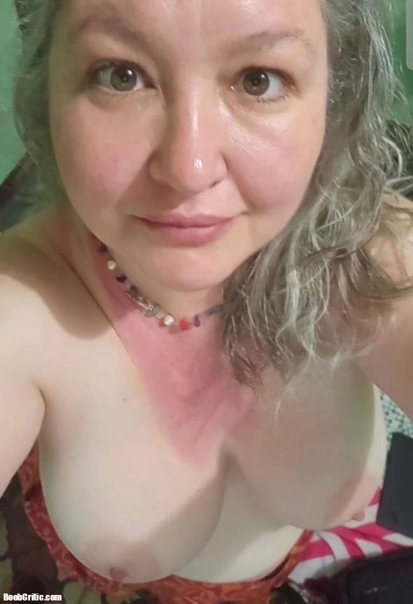 Sunburn but tits are fine