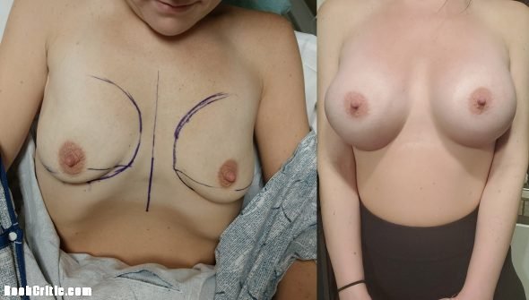 Big fake tits wife before and after